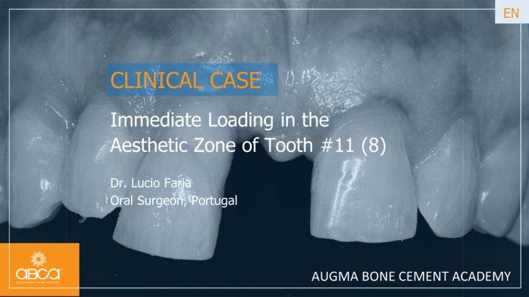 Immediate Loading in the Aesthetic Zone of Tooth 